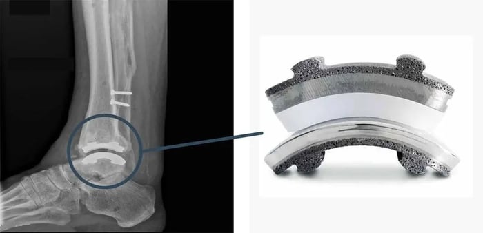 Radiografia di un piede con protesi di caviglia e foto dell'impianto usato.