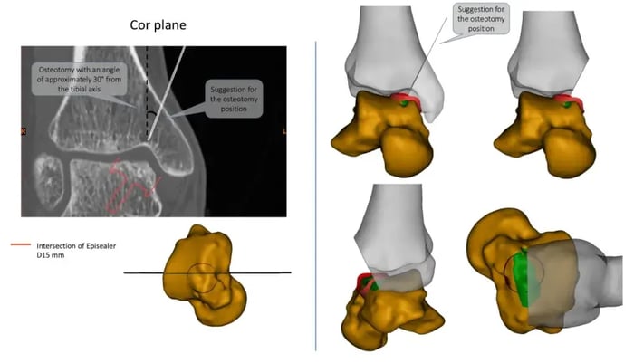 Imaging per la pianificazione di un'osteotomia.