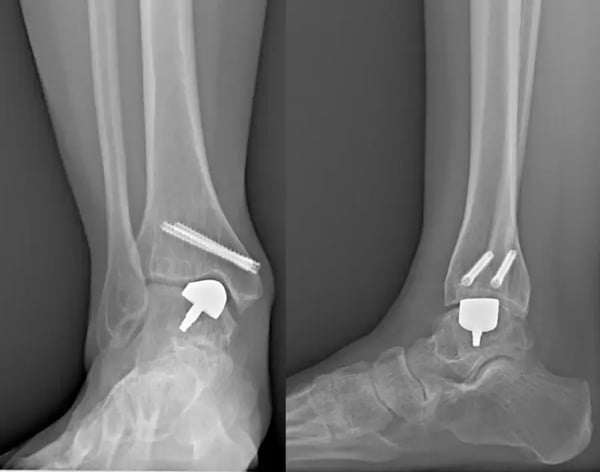 Radiografie del piede di una paziente con mini-protesi su misura.