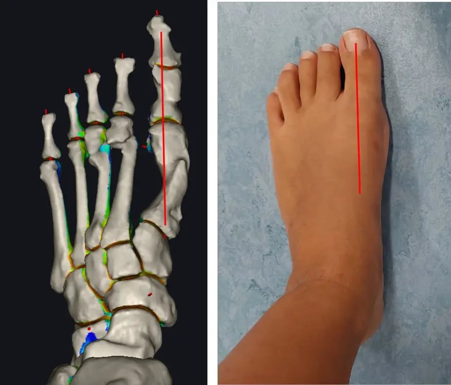 Foto di un piede dopo l'intervento all'alluce valgo, affiancata alla ricostruzione 3D della correzione scheletrica.