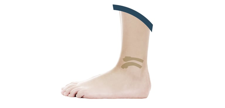 fix-bearing-prothesis-min