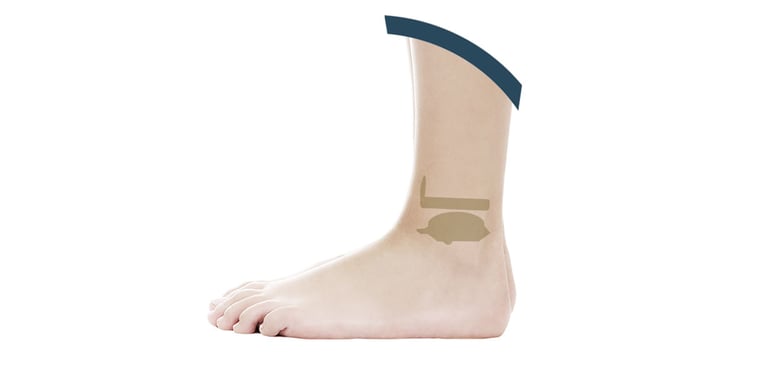 mobile-bearing-prothesis-min