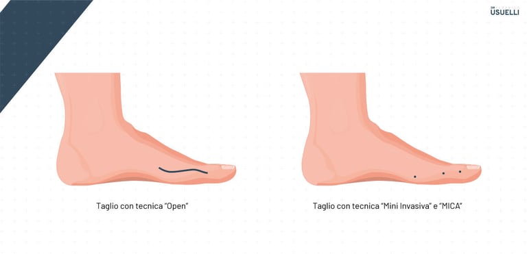 alluce valgo tecnica mica