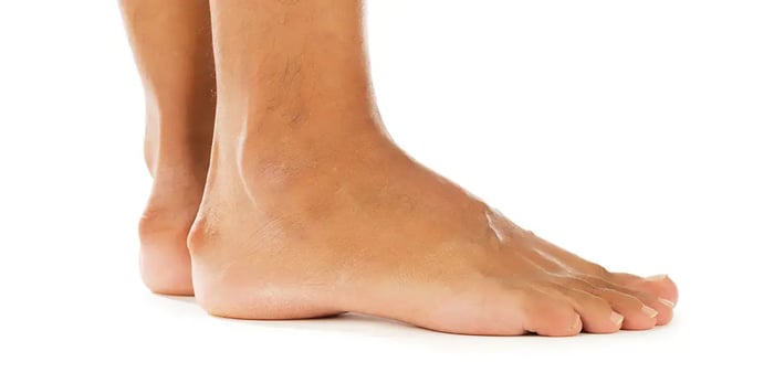 Foto che mostra la presenza del morbo di Haglund su entrambi i piedi.