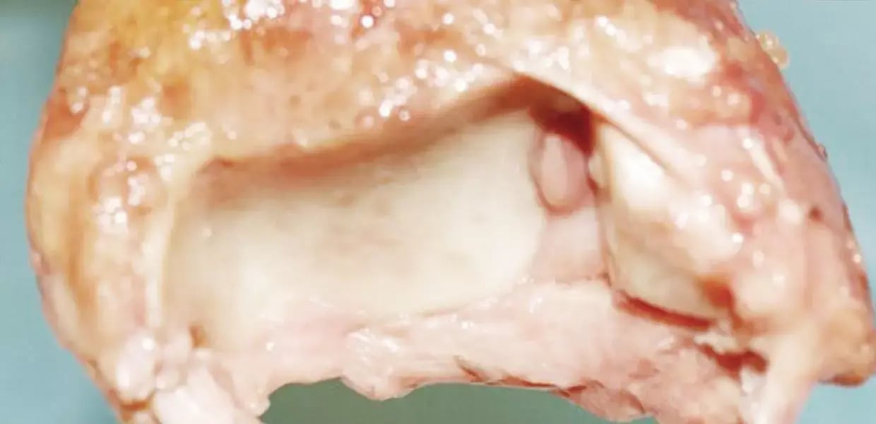 tibio-tarsica-dr-usuelli