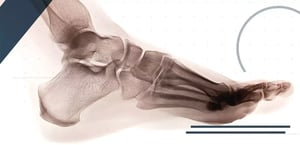 LISFRANC-INJURIES-IN-SPORT-min