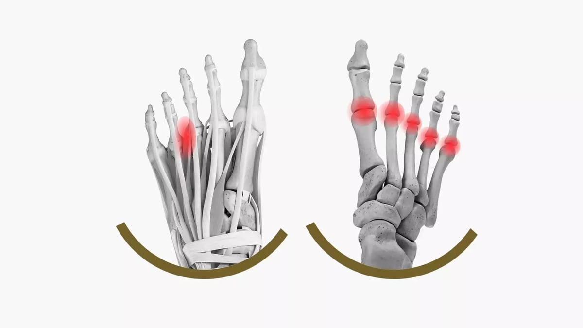 Neuroma di Morton e Metatarsalgia