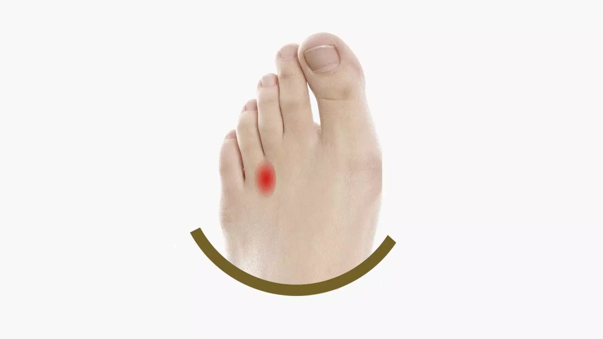 Neuroma di Morton