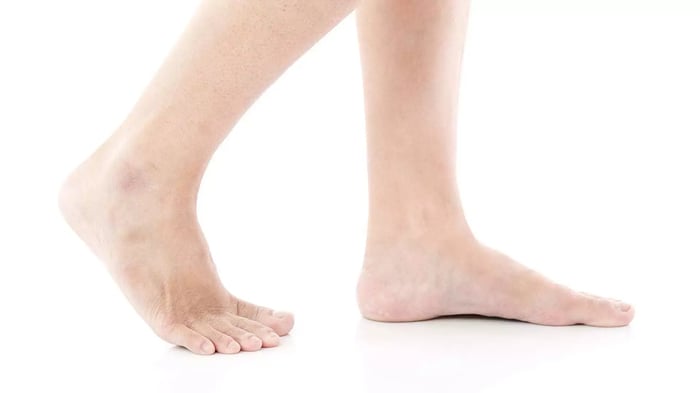 Paziente reduce da un intervento di piede piatto che cammina a piedi nudi.