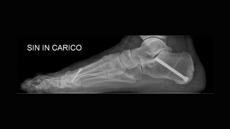 Imaging del piede di un paziente con piede piatto dopo la ricostruzione della deformità.