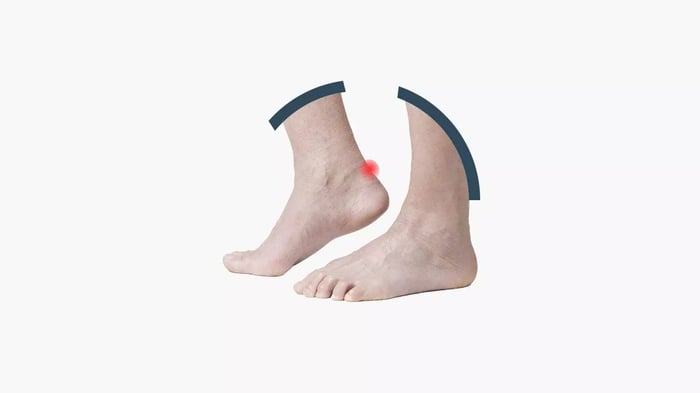 Foto che mostra la collocazione della tendinopatia inserzionale achillea lungo il decorso del tendine.