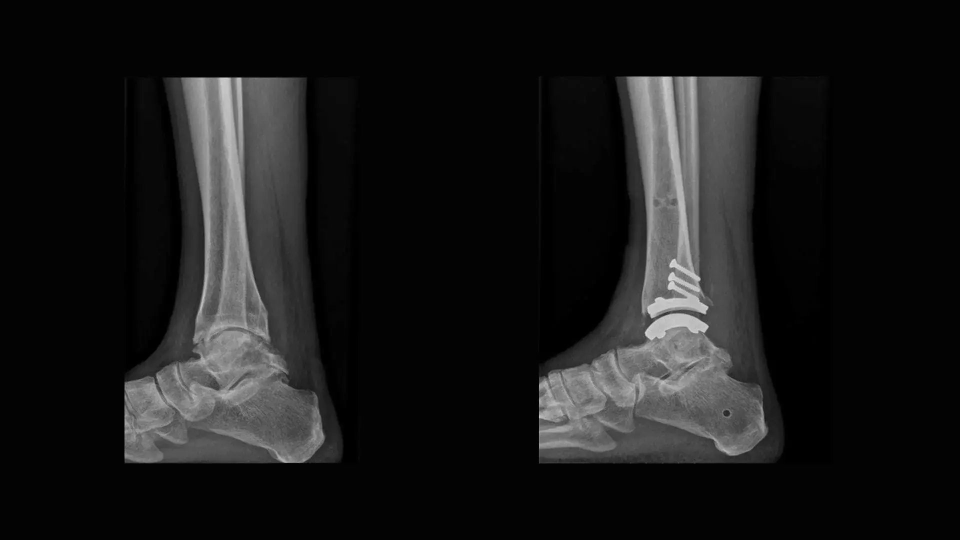 resurfacing-lastre-intervento-desktop-min.jpg
