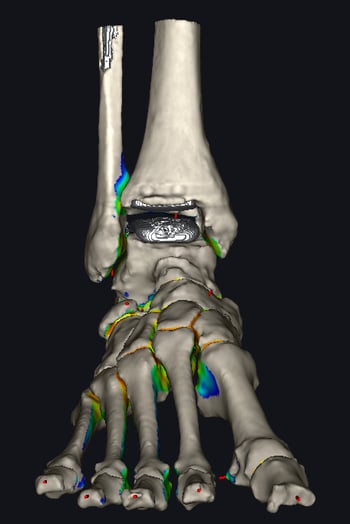 Imaging pre-operatorio per la revisione di una protesi BOX.