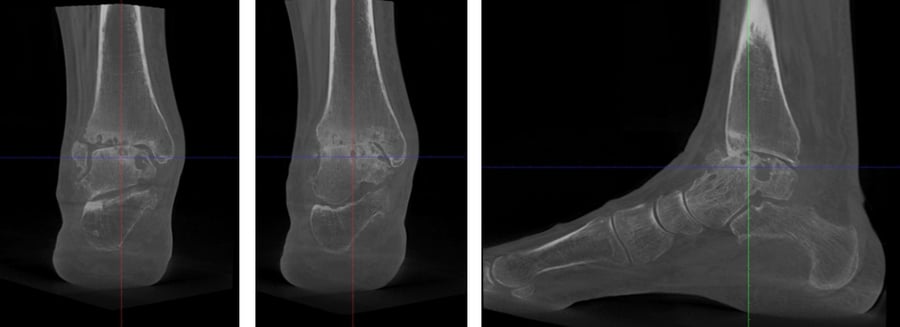TAC che mostra il piede di un paziente affetto da artrosi di caviglia.