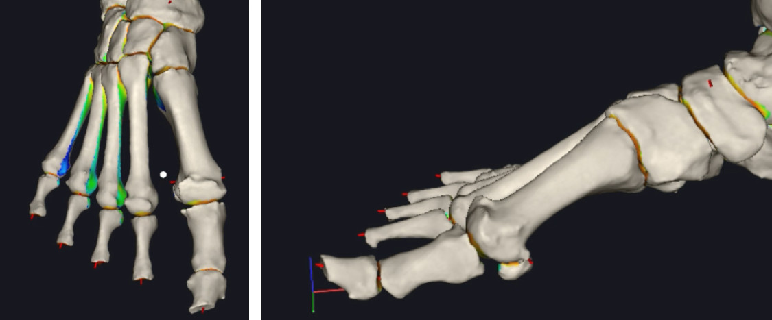 TAC osteofiti alluce rigido