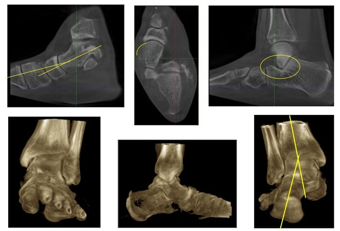 Tac in carico piede piatto pre trattamento