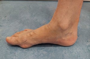 Foto di un piede con alluce rigido, con la deformita evidenziata da un segno.