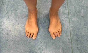 Foto di una paziente con alluce valgo bilaterale e dita a griffe.