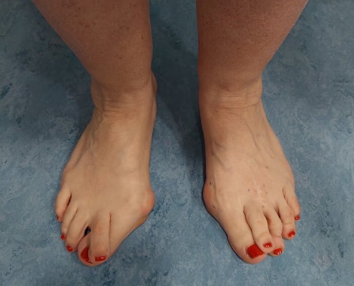 Foto dei piedi di una paziente con alluce valgo e sovrapposizione del secondo dito.