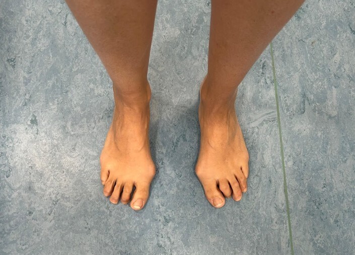 Foto dei piedi di paziente con alluce valgo e dita a griffe.