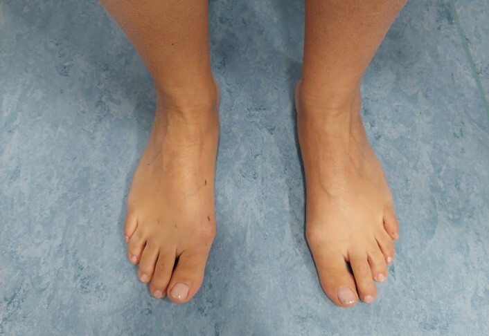 Foto dei piedi di una paziente con alluce valgo, la cui deformità è ancora ridotta e allo stadio iniziale.