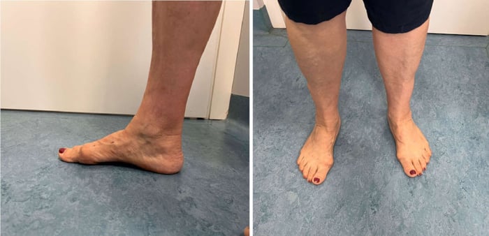 Foto di paziente con alluce valgo pre-intervento.