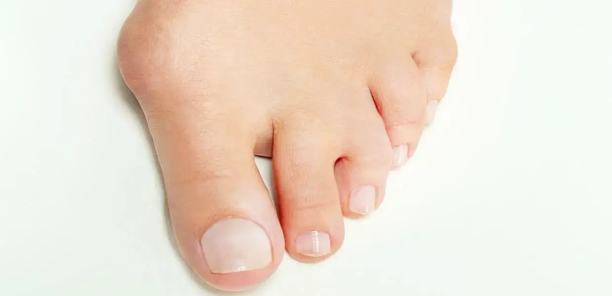 alluce-valgo-piede-femminile-min