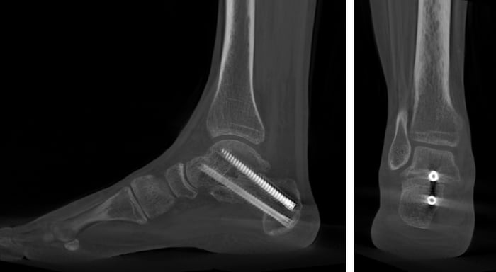Imaging di un'artrodesi per la correzione di un piede piatto.