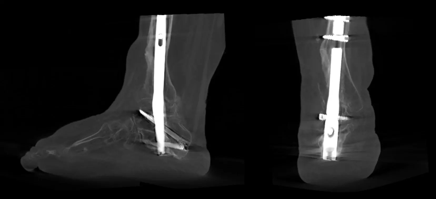 Imaging di artrodesi tibiotalocalcaneare.