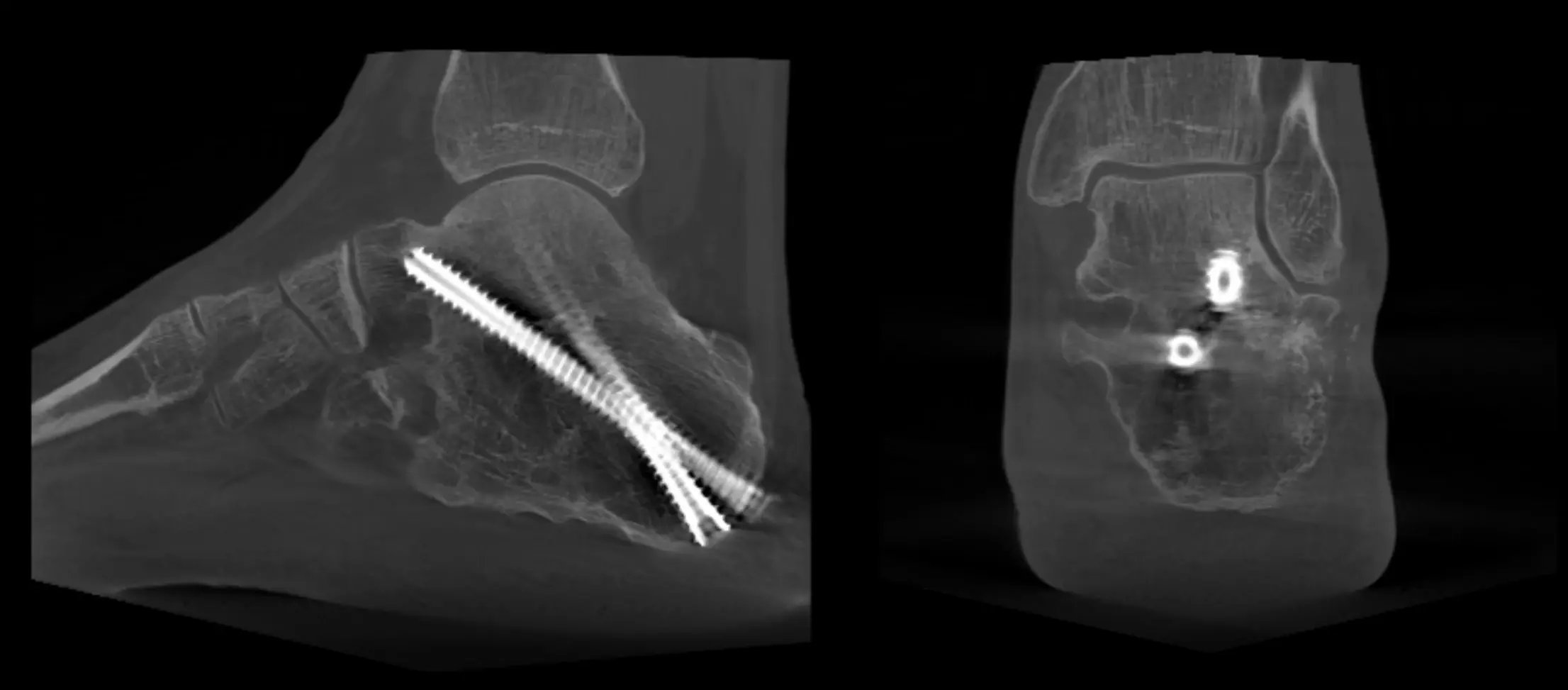 Imaging di sola artrodesi sottoastragalica.