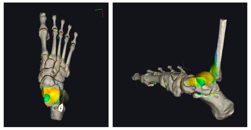 Imaging 3D del piede di un paziente affetto da lesione alla cartilagine della caviglia.