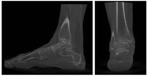 Cartilagine caviglia: imaging pre-operatorio che mostra una lesione osteocondrale.