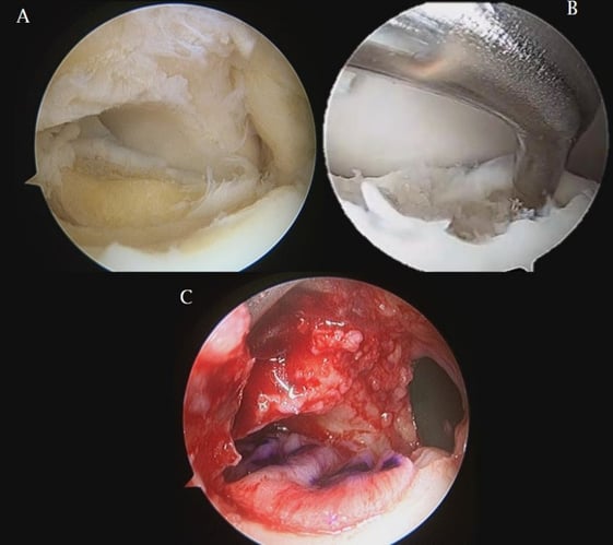 Cartilagine caviglia: immagini riprese durante un intervento.