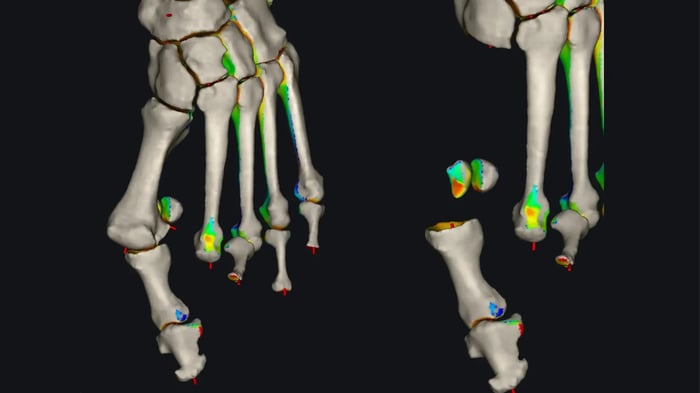 Imaging di un caso di alluce valgo nella fase pre-operatoria.