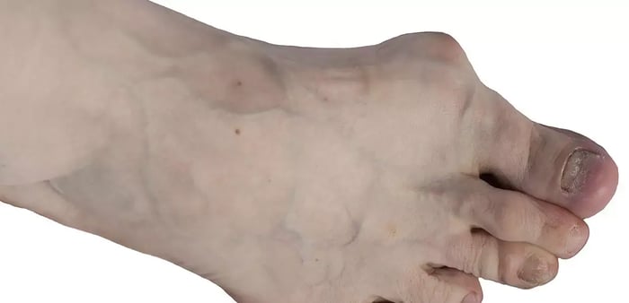 Foto di un piede con alluce valgo che presenta i sintomi visibili della borsite e delle patologie all'unghia.