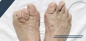 deformita-del-piede-min
