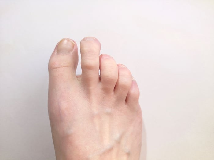 Foto di un piede con dita a griffe.