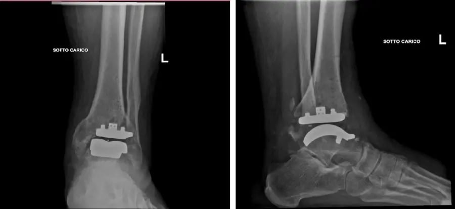 Radiografia post-operatoria di paziente con protesi Exactech.