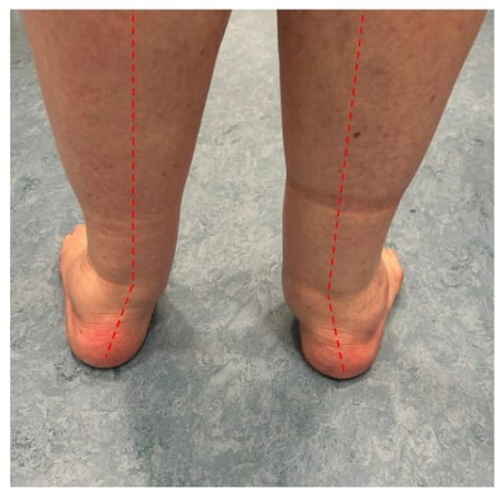 foto di paziente con piede piatto