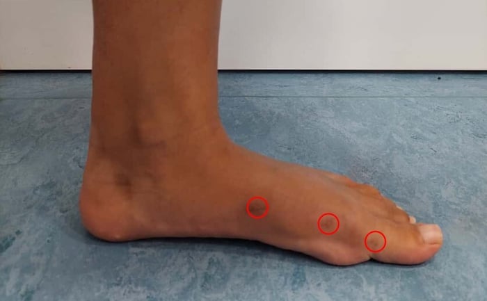 Foto di un piede post operazione per alluce valgo con evidenziate le cicatrici dei fori d'ingresso per l'intervento.