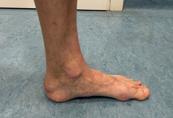 Immagine clinica relativa a un caso di tendinopatia achillea inserzionale.