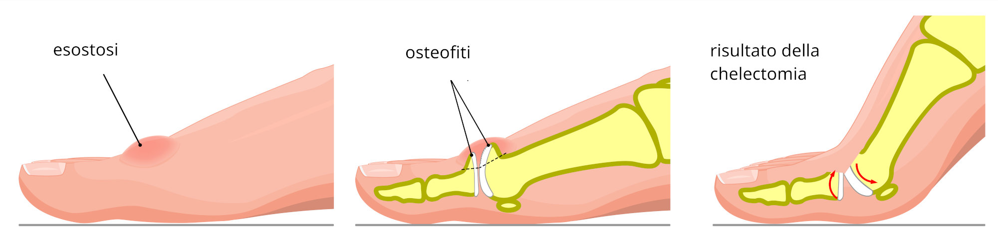 Grafica che rappresenta un alluce rigido, con esostosi in rilievo, dettaglio degli osteofiti e risultato di un intervento di chelectomia.