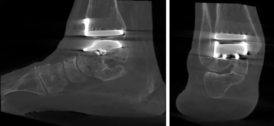 Imaging post-operatorio di paziente con protesi Hintegra.