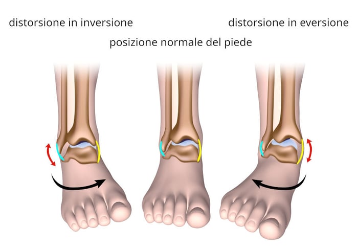 Illustrazione che mostra una distorsione di caviglia in inversione e una in eversione a confronto con la posizione normale del piede.