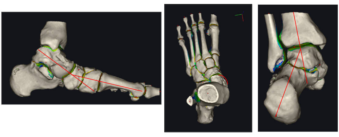 Ricostruzione DISIOR TAC in carico con evidenziati i parametri alterati.