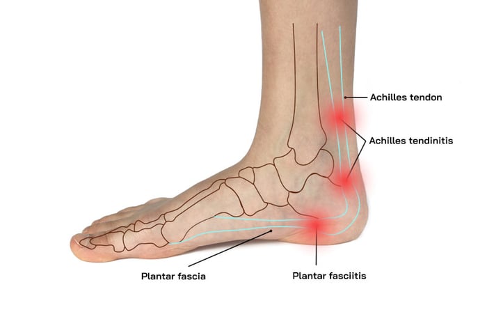 Illustrazione che mostra il legame fra tendine d'achille e fascite plantare.