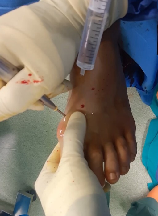 Foto di un intervento di chirurgia mininvasiva al piede.