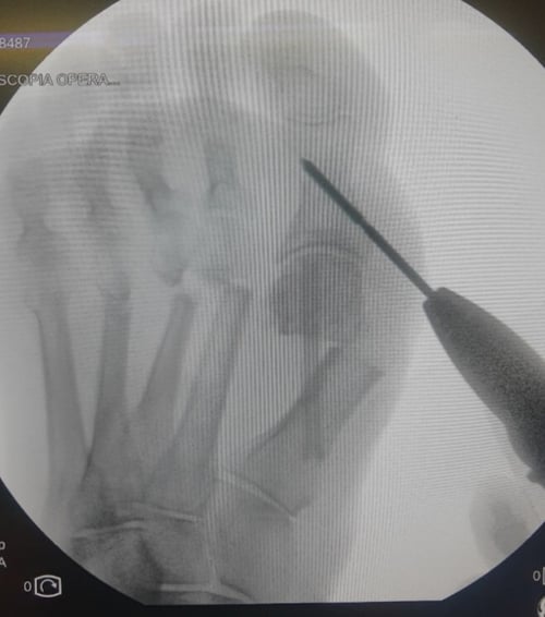 Imaging di un intervento di chirurgia mininvasiva al piede.