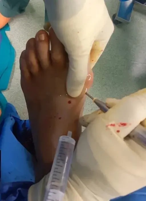 Foto di un intervento miniinvasivo su paziente con alluce valgo.