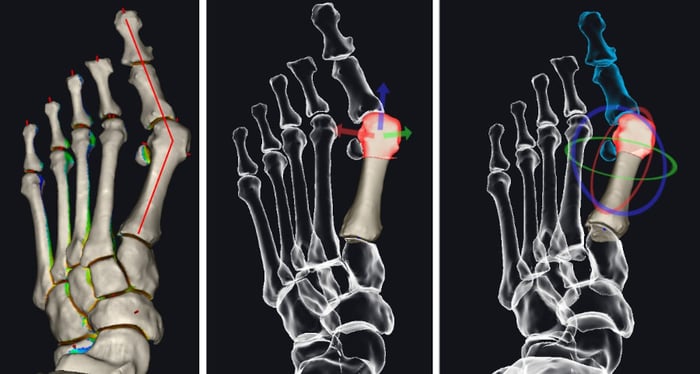 Modello 3D con assi di deformità ricavato da una tac in carico e usato per il processo pre-operatorio.